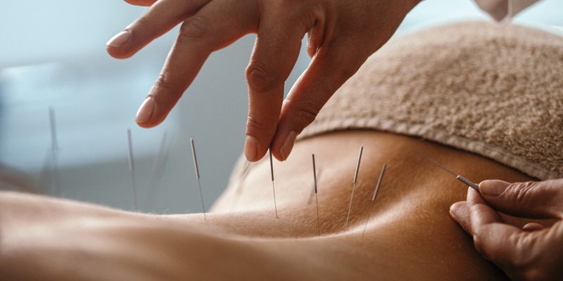 acupuncture